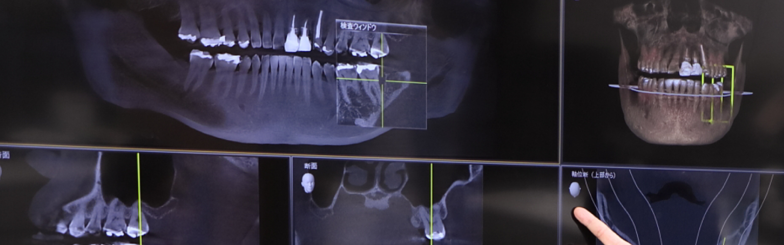 福岡で安心してインプラント治療を