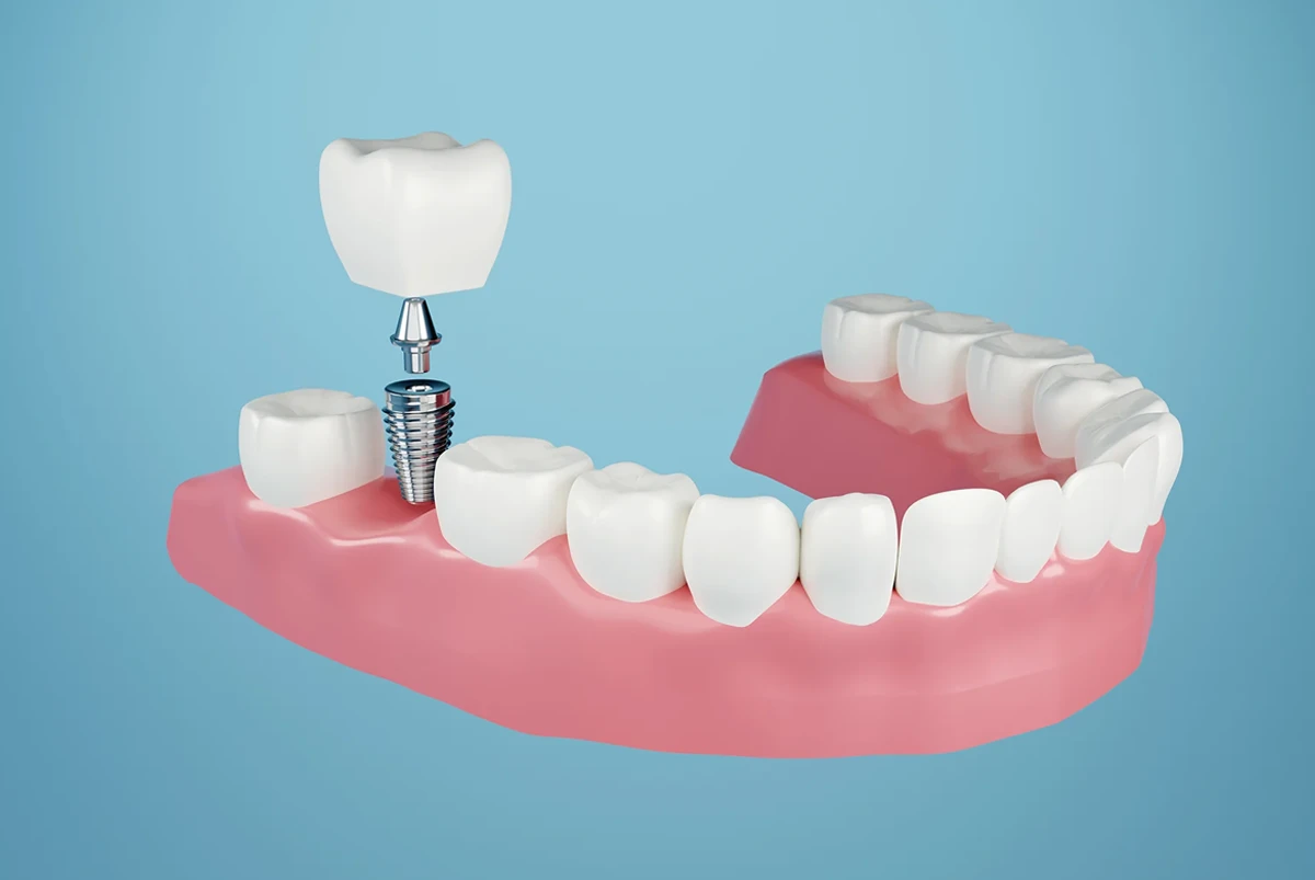 インプラント治療が選ばれる理由